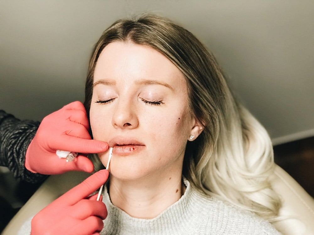 filler on client's lips