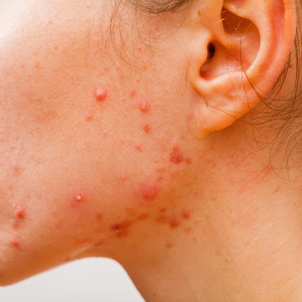 acne skin condition on jawline