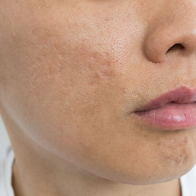 acne scars treatments