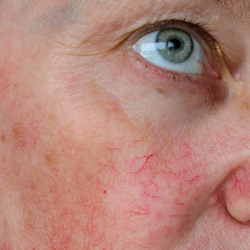 closeup of capillaries on cheek