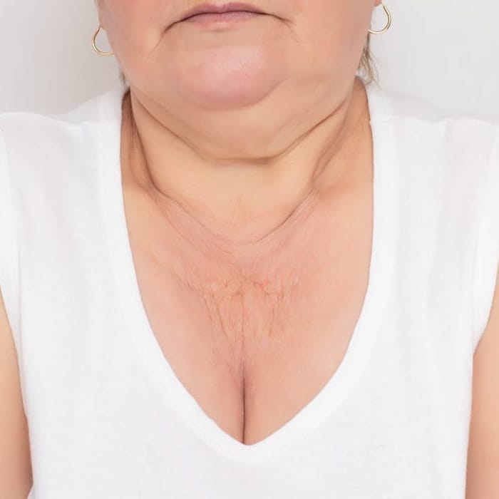 chest lines and wrinkles