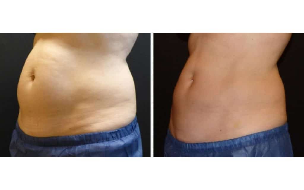 CoolSculpting stomach before and after