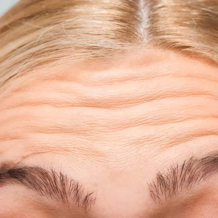 forehead lines and wrinkles