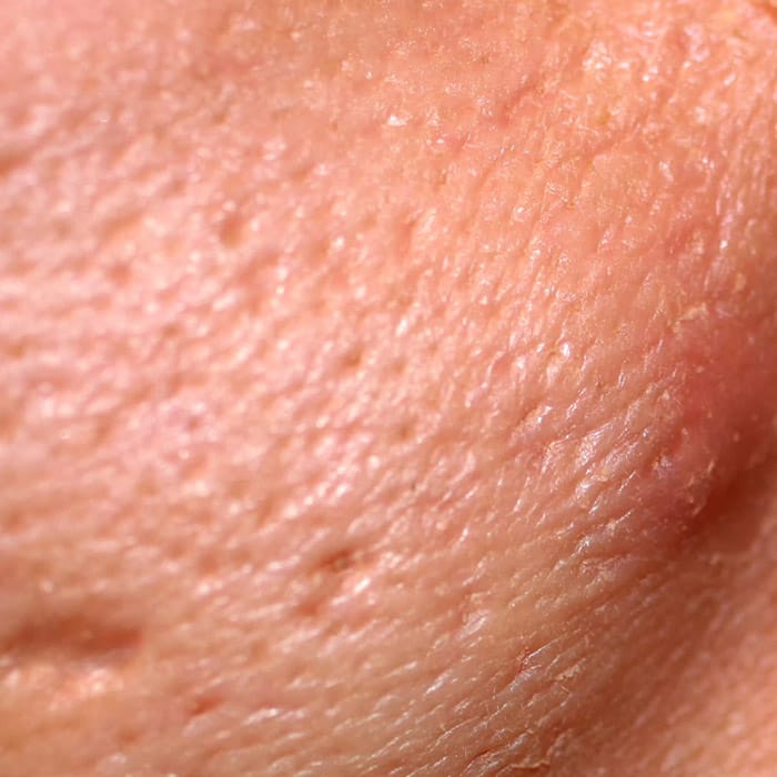 large pores