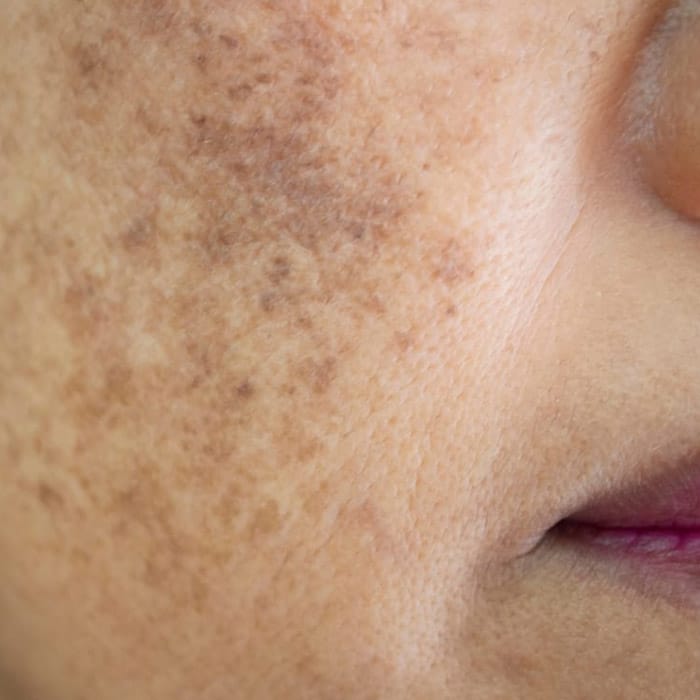 melasma on cheek