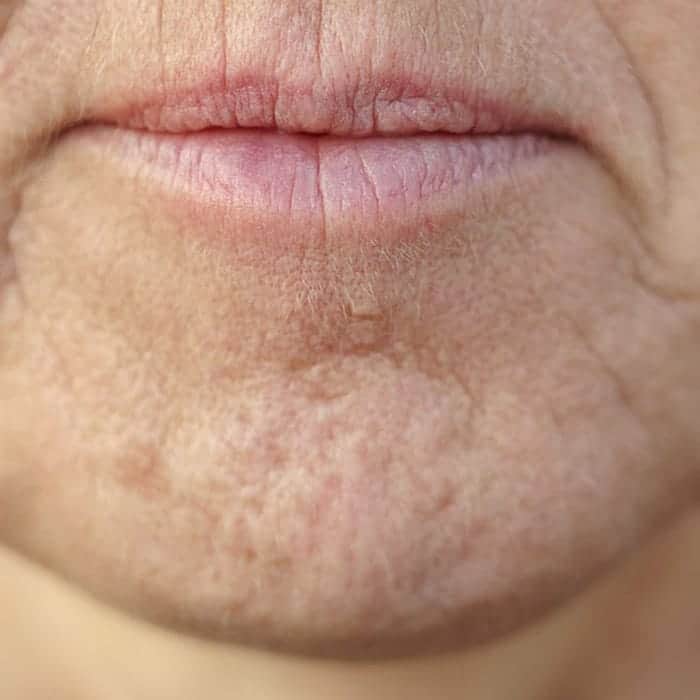 mouth wrinkles