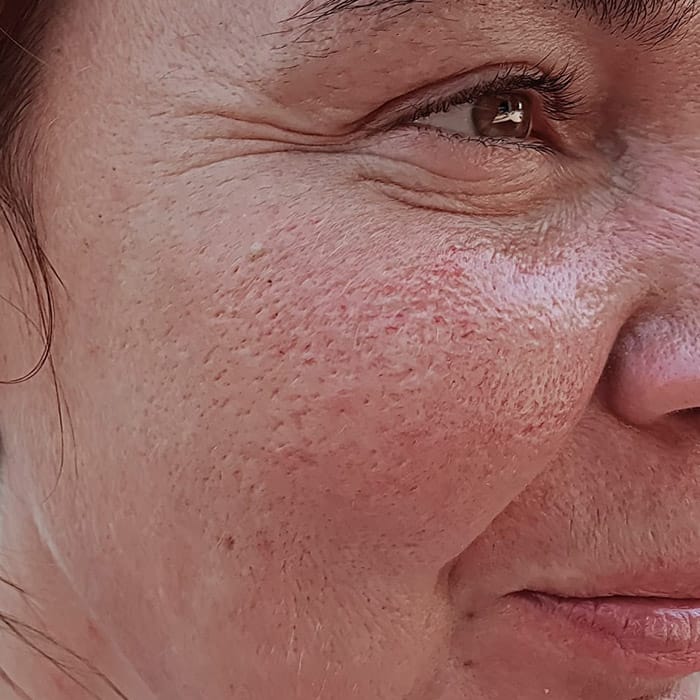 uneven skin texture
