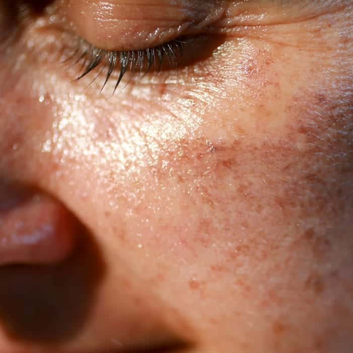 sun damaged skin