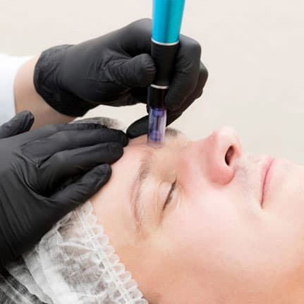 microneedling service on male client