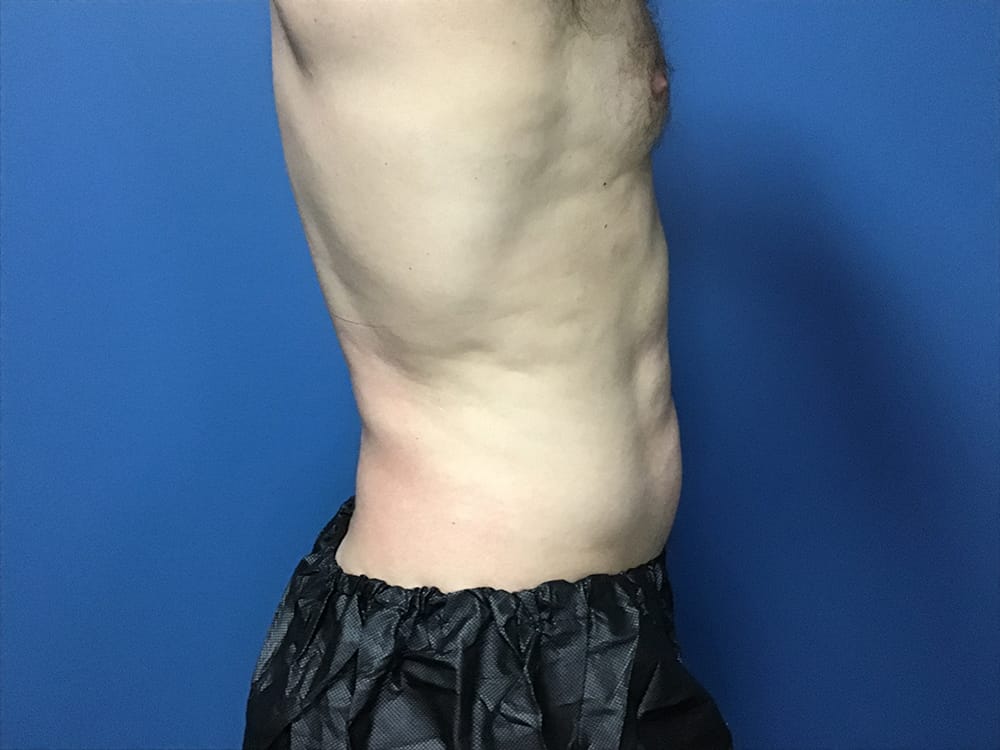 Cool Combo treatment after image of client result