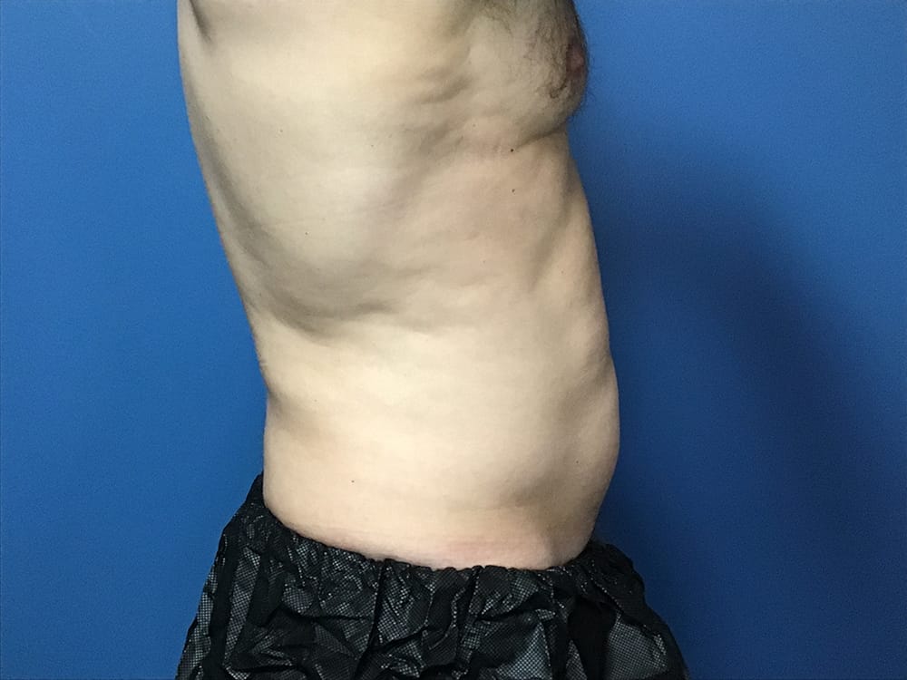 Cool Combo treatment before image of client