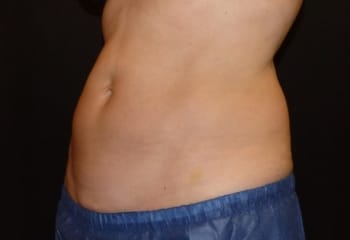 Cool Combo treatment after image of client result