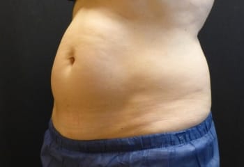 Cool Combo treatment before image of client