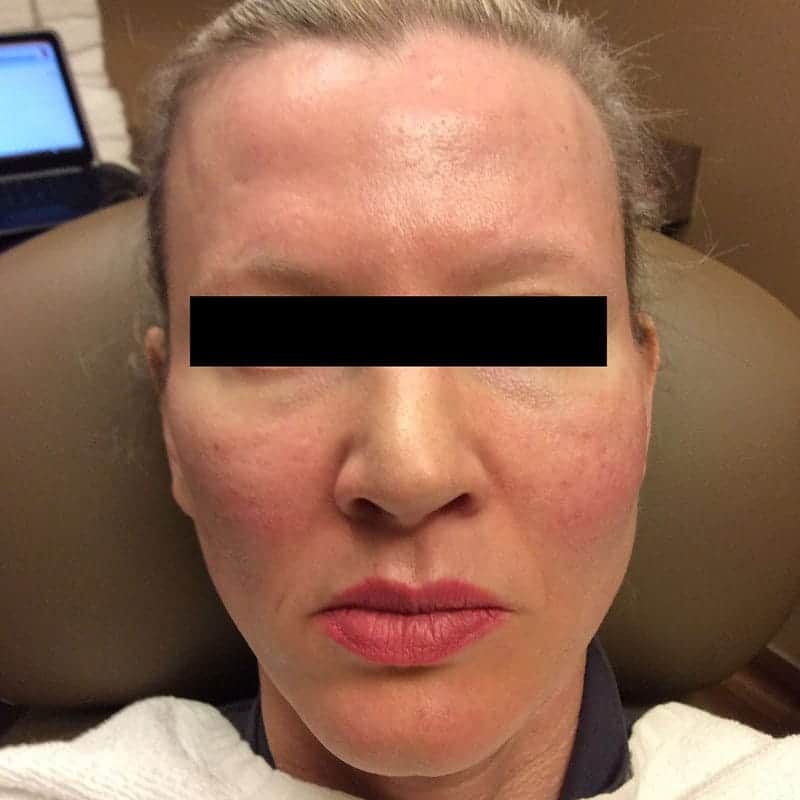 Liquid Refresh treatment after client result