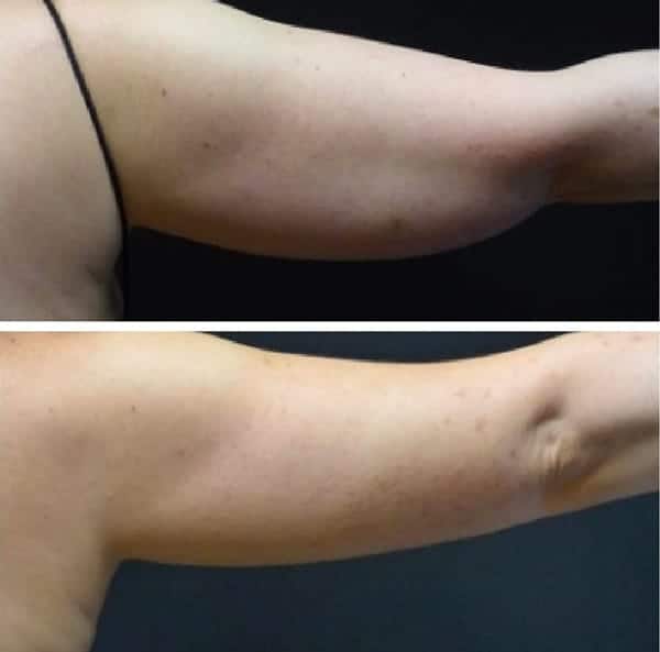 CoolSculpting before and after