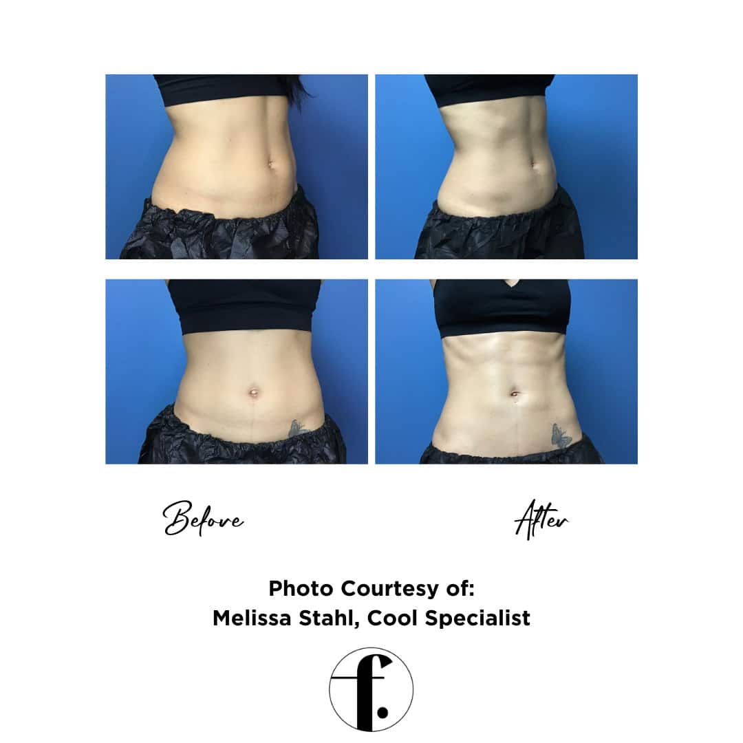 coolsculpting before and after