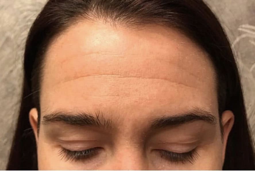 client before forehead treatment