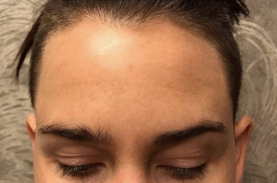 client after forehead treatment