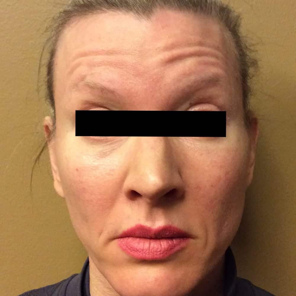 botox before image