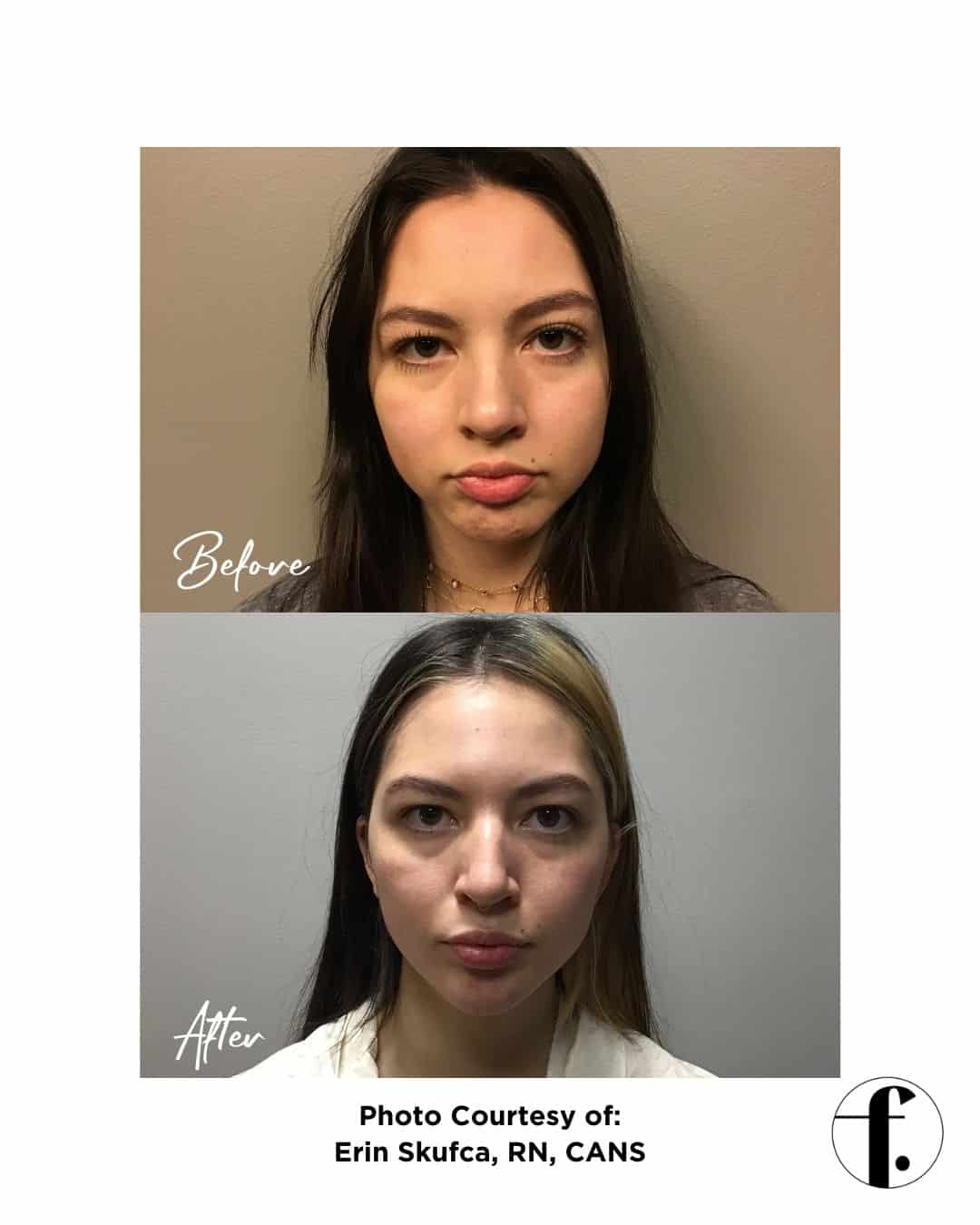 jawline filler Before and After