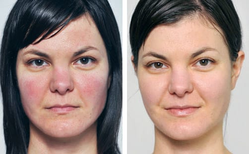 Spa Facials before and after