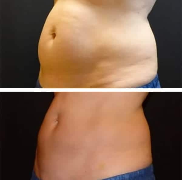 CoolSculpting Denver before and after
