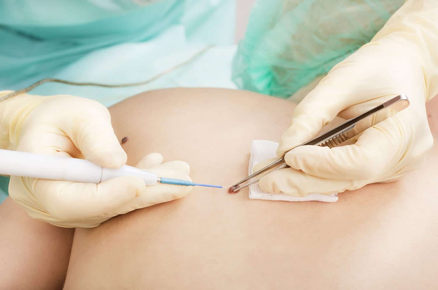 hyfrecation treatment on mole