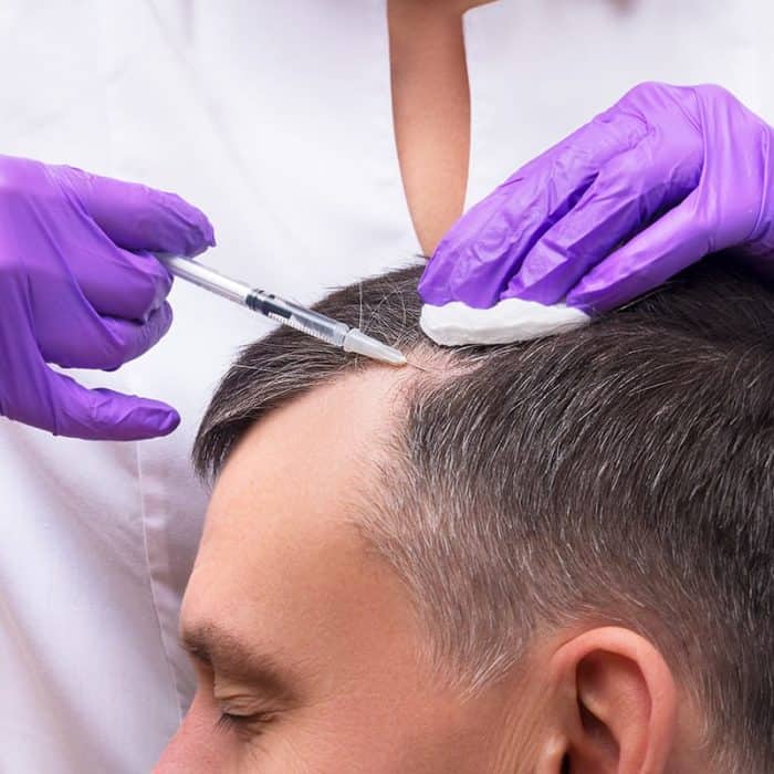 prp treatment on man's hair