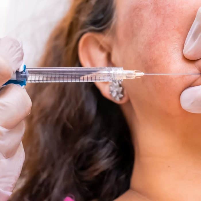 client getting Juvederm Fillers