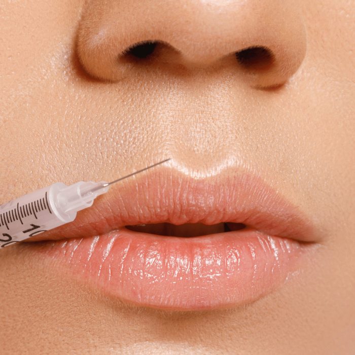 lip filler