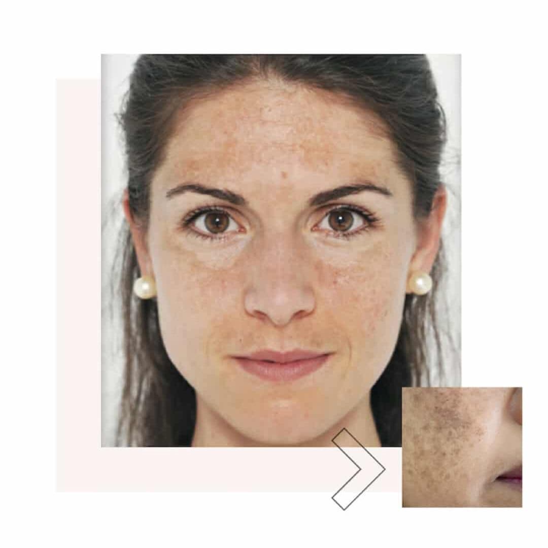 women with MELASMA