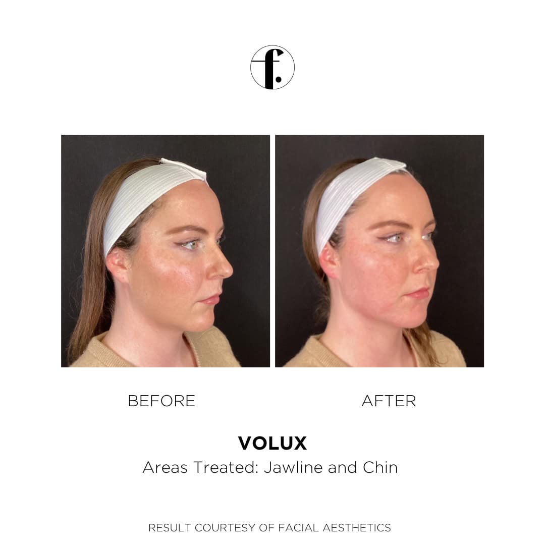 Female Juvéderm Volux Before and After 3