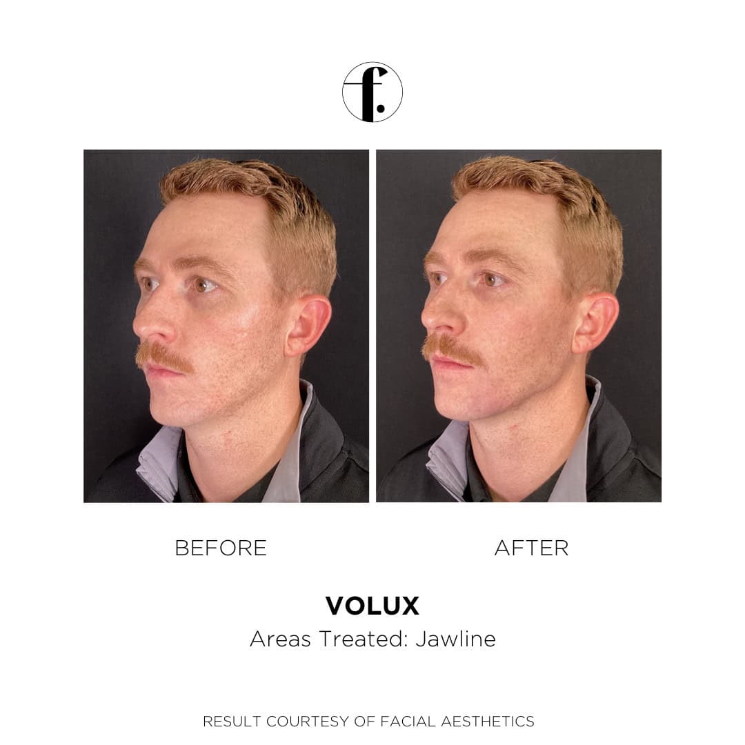 Male Juvéderm Volux