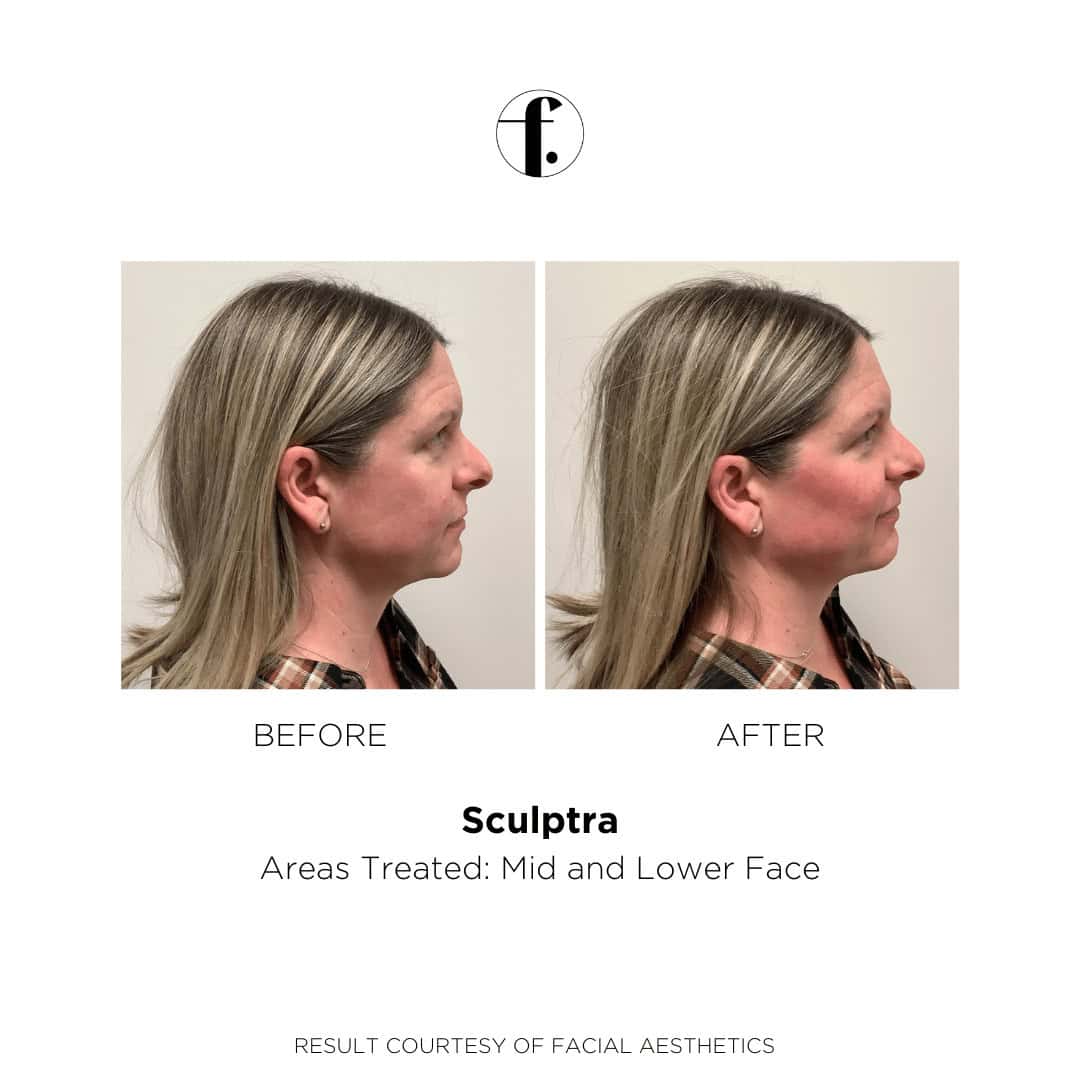 Sculptra Before and After