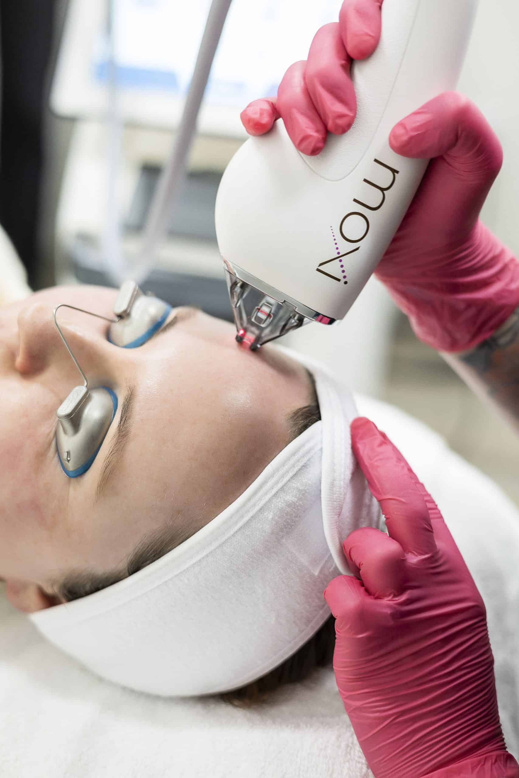 moxi laser