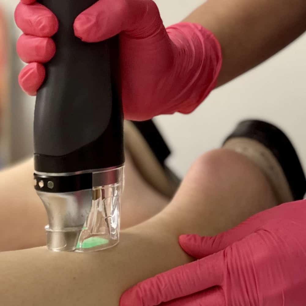 Laser Hair Removal at Facial Aesthetics