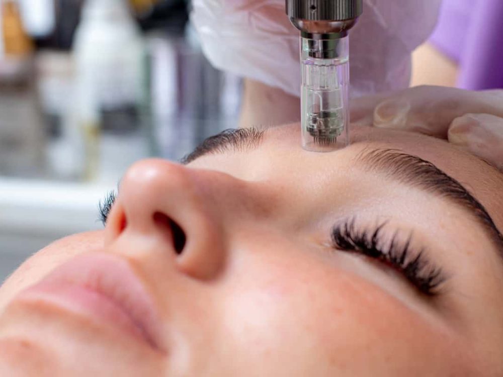 microneedling on model