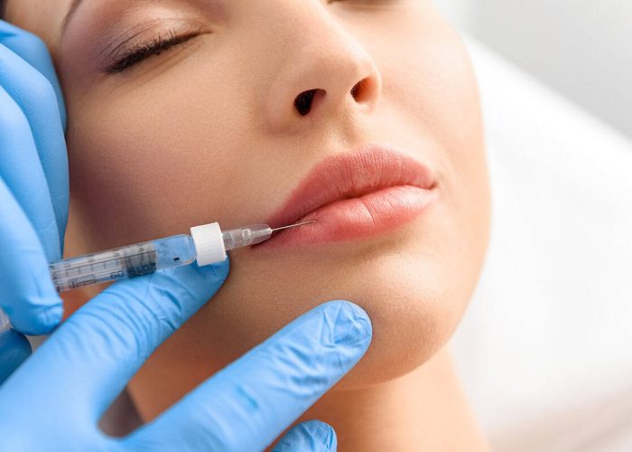 lip filler